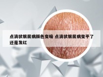 点滴状银屑病颜色变暗 点滴状银屑病变平了还是发红