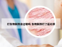 打生物制剂会过敏吗 生物制剂打了起红疹