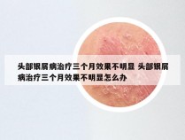 头部银屑病治疗三个月效果不明显 头部银屑病治疗三个月效果不明显怎么办