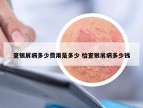 查银屑病多少费用是多少 检查银屑病多少钱