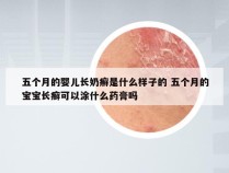 五个月的婴儿长奶癣是什么样子的 五个月的宝宝长癣可以涂什么药膏吗