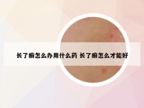 长了癣怎么办用什么药 长了癣怎么才能好