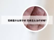 花癣是什么样子的 花癣怎么治疗好哪?