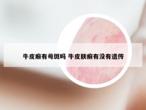 牛皮癣有母斑吗 牛皮肤癣有没有遗传