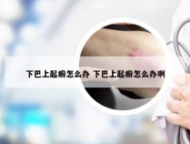 下巴上起癣怎么办 下巴上起癣怎么办啊