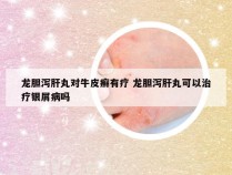 龙胆泻肝丸对牛皮癣有疗 龙胆泻肝丸可以治疗银屑病吗