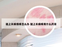 腿上长癣很痒怎么办 腿上长癣痒用什么药膏