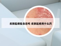 皮肤起癣能自愈吗 皮肤起癣用什么药