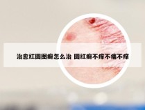 治愈红圆图癣怎么治 圆红癣不痒不痛不痒