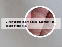 小孩皮肤有白块是怎么回事 小孩皮肤上有一大块白色的是什么