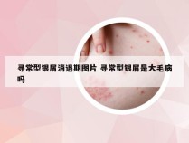 寻常型银屑消退期图片 寻常型银屑是大毛病吗