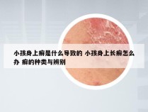 小孩身上癣是什么导致的 小孩身上长癣怎么办 癣的种类与辨别