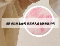 银屑病能带宝宝吗 银屑病人适合抚养孩子吗