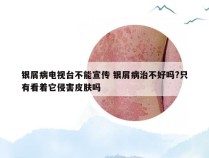 银屑病电视台不能宣传 银屑病治不好吗?只有看着它侵害皮肤吗