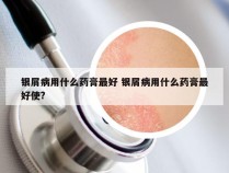 银屑病用什么药膏最好 银屑病用什么药膏最好使?