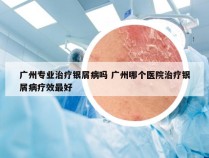 广州专业治疗银屑病吗 广州哪个医院治疗银屑病疗效最好