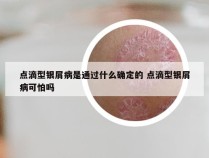 点滴型银屑病是通过什么确定的 点滴型银屑病可怕吗