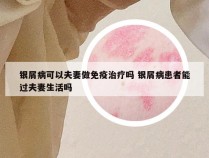 银屑病可以夫妻做免疫治疗吗 银屑病患者能过夫妻生活吗