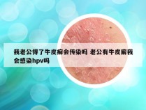 我老公得了牛皮癣会传染吗 老公有牛皮廨我会感染hpv吗