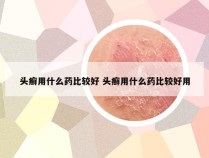 头癣用什么药比较好 头癣用什么药比较好用