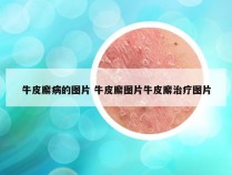 牛皮廨病的图片 牛皮廨图片牛皮廨治疗图片