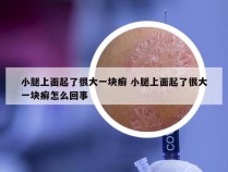 小腿上面起了很大一块癣 小腿上面起了很大一块癣怎么回事