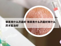 银屑用什么药最好 银屑用什么药最好用什么药才能治好