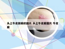 头上牛皮肤癣的图片 头上牛皮廨图片 牛皮廨