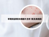 早期局部银肖病图片怎样 银肖病病因