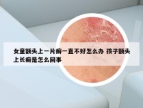 女童额头上一片癣一直不好怎么办 孩子额头上长癣是怎么回事