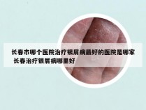 长春市哪个医院治疗银屑病最好的医院是哪家 长春治疗银屑病哪里好