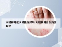 大钱癣用纸大钱能治好吗 大钱癣用什么药膏好使