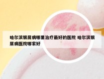 哈尔滨银屑病哪里治疗最好的医院 哈尔滨银屑病医院哪家好