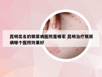 昆明出名的银屑病医院是哪家 昆明治疗银屑病哪个医院效果好