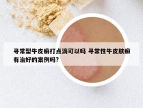 寻常型牛皮癣打点滴可以吗 寻常性牛皮肤癣有治好的案例吗?