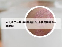 小儿长了一块块的癣是什么 小孩皮肤好像一块块癣