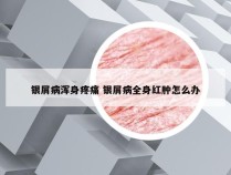 银屑病浑身疼痛 银屑病全身红肿怎么办