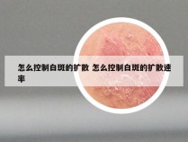 怎么控制白斑的扩散 怎么控制白斑的扩散速率