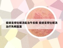 柴胡龙骨牡蛎汤能治牛皮癣 柴胡龙骨牡蛎汤治疗失眠医案