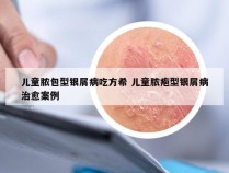 儿童脓包型银屑病吃方希 儿童脓疱型银屑病治愈案例