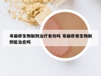 寻麻疹生物制剂治疗有效吗 荨麻疹用生物制剂能治愈吗