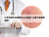 六岁宝宝牛皮癣是什么引起的 儿童牛皮肤癣原因