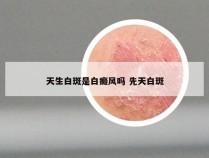 天生白斑是白癜风吗 先天白斑