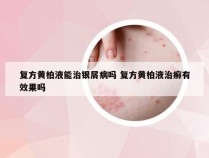 复方黄柏液能治银屑病吗 复方黄柏液治癣有效果吗