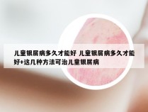 儿童银屑病多久才能好 儿童银屑病多久才能好+这几种方法可治儿童银屑病