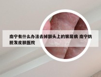 南宁有什么办法去掉额头上的银屑病 南宁防脱发皮肤医院