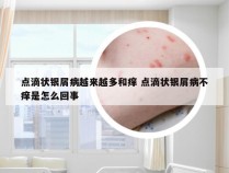 点滴状银屑病越来越多和痒 点滴状银屑病不痒是怎么回事