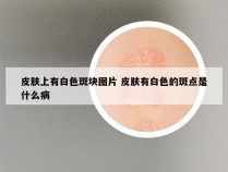 皮肤上有白色斑块图片 皮肤有白色的斑点是什么病