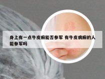 身上有一点牛皮癣能否参军 有牛皮病癣的人能参军吗