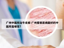 广州中医院治牛皮癣 广州看银屑病最好的中医院是哪家?